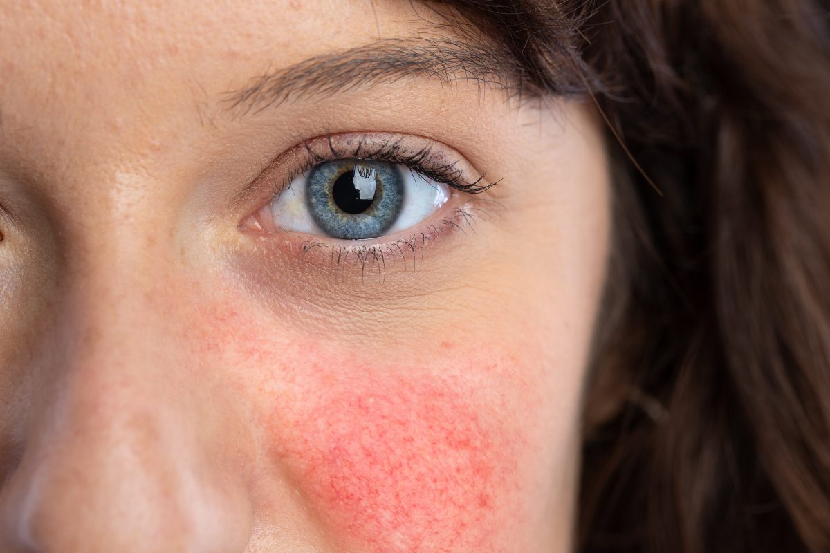 Comment prendre soin d'une peau réactive avec rougeur sur le visage ...