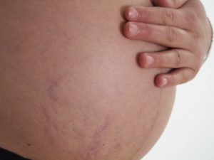 Vergetures de grossesse : comment les éviter ?